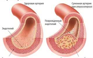Кимерли аномалия лечение