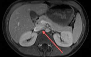 МРТ и КТ (магнитно-резонансная и компьютерная томография) поджелудочной железы при панкреатите