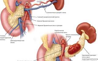 Резекция головки и хвоста поджелудочной железы дистальная и ее последствия