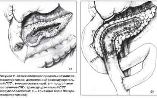 Хирургия хронического панкреатита, операции
