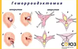 Операция по удалению геморроидальных шишек