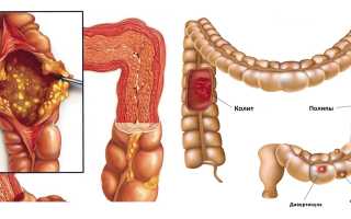Колит толстого кишечника