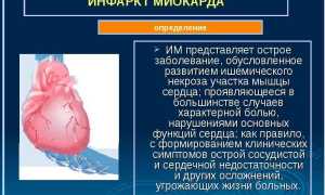 Кардиограмма сердца при инфаркте