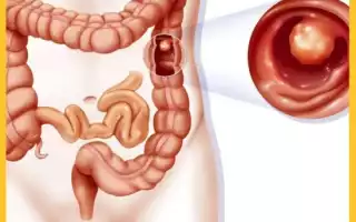Как осуществляется профилактика полипов в кишечнике?
