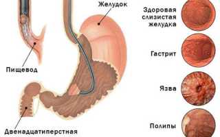 ФГДС при раке желудка