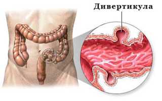 Дивертикулёз прямой кишки у человека