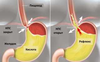 Рефлюкс эзофагит 1 степени