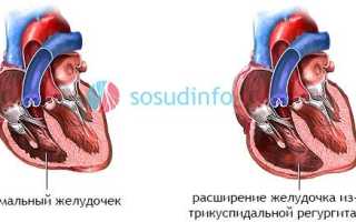 Гипертрофия правого желудочка развивается при