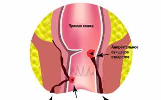 Симптомы парапроктита