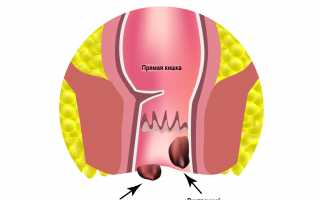 Почему болит живот внизу при геморрое?