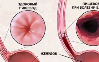 Операция при эзофагите