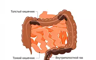 Как определить запор?