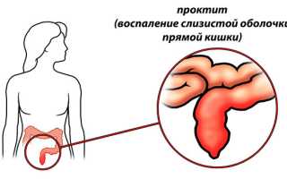 Симптомы хронического проктита