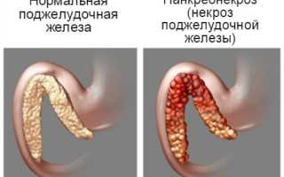 Отек поджелудочной железы при панкреатите