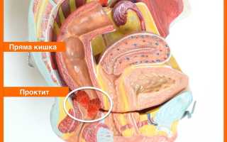 Медикаментозное лечение проктита