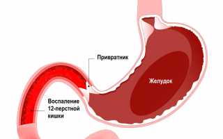 Проксимальный дуоденит, что это такое?