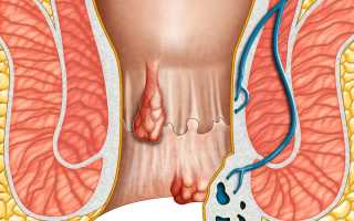Возможные осложнения на анусе после удаления геморроя