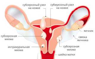 Миома головного мозга