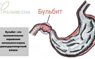 Народное лечение бульбита двенадцатиперстной кишки