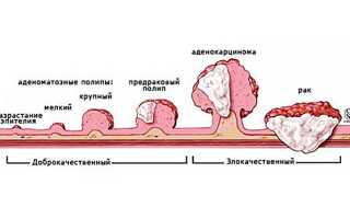 Чем опасны полипы в кишечнике?