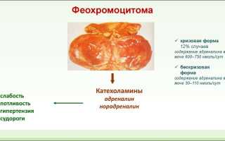 Диагностика и анализы при феохромоцитоме