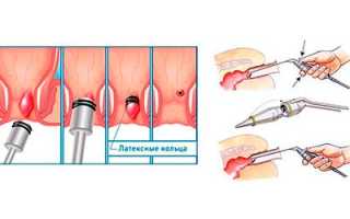 Как быстро убрать геморроидальные узлы?