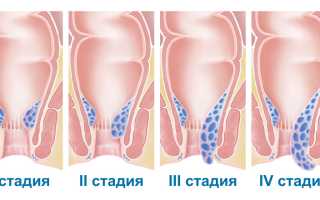 Лечение геморроя в поликлинике