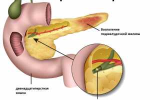 Билирубин поджелудочной железы при панкреатите