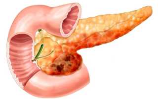 Что делать, если обострился панкреатит – что пить, как и чем снять обострение поджелудочной железы?