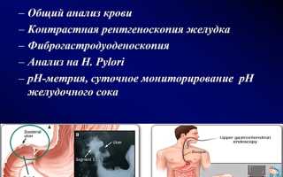 Медицина о язве 12-перстной кишки: этиология и патогенез