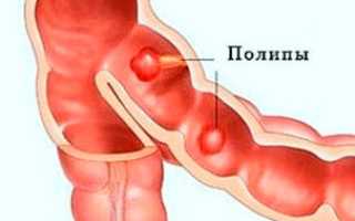Полипы 12-перстной кишки