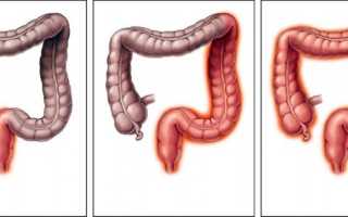 Хронический колит в стадии обострения