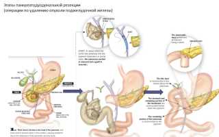 Удаление опухоли – операция при раке поджелудочной железы