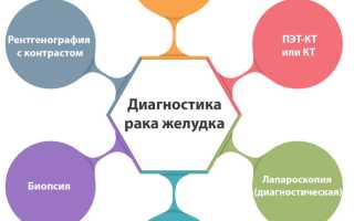 Ранняя диагностика рака желудка: как распознать заболевание и поставить диагноз?