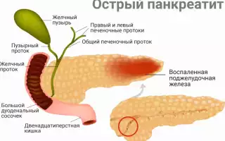 Острый послеоперационный панкреатит и его лечение