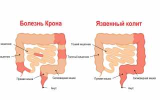 Вторичный колит (рецидивирующий)