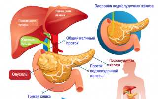 Хвост поджелудочной железы – лечение образований, как болит, куда проецируется?