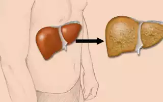 Стеатоз поджелудочной железы и печени – симптомы, признаки, лечение, диета