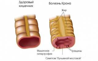 Болезнь Крона