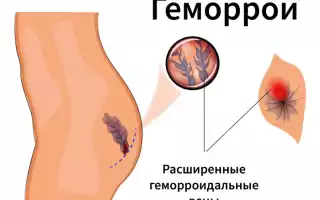 Почему появляется геморрой у нерожавших девушек?