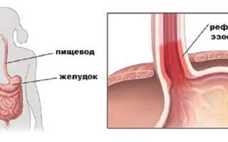 Дистальный или катаральный рефлюкс-эзофагит, симптомы и лечение