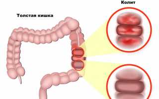 Какие антибиотики принимать при колите?