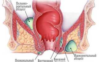Парапроктит – заболевание прямой кишки