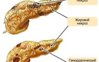 Жировой панкреонекроз (некроз поджелудочной железы)