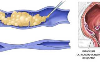 Склеротерапия геморроя – склерозирование геморроидальных узлов