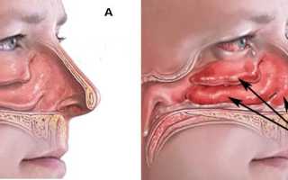 Насморк и лругие симптомы глистов в носу