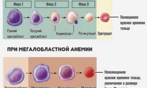 Мегалобластическая анемия