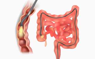 Катаральный колит кишечника