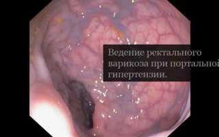 Расширение вен при геморрое, венозные сплетения