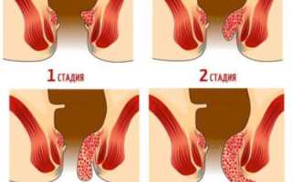 Геморрой 1-2 стадии (второй степени)